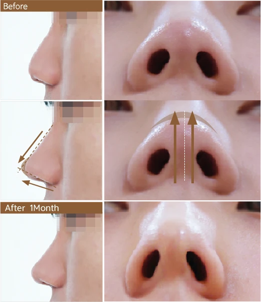 Nose