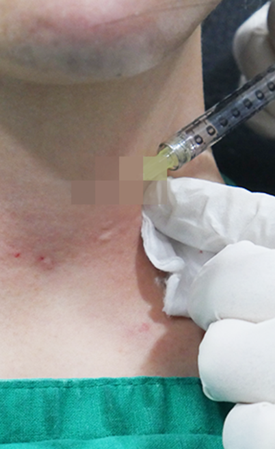 Filler2
