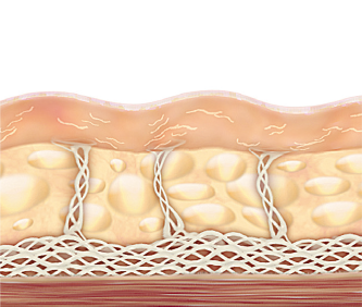 Skin sagging due to weakened collagen