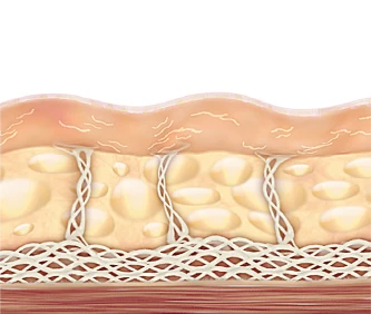 Skin sagging due to weakened collagen