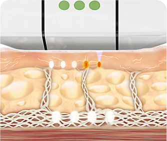 Ulthera Treatment
