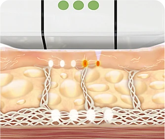 Ulthera Treatment