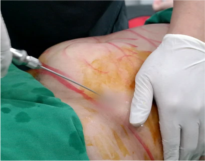 procedure