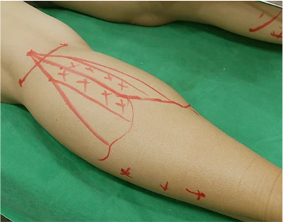 procedure