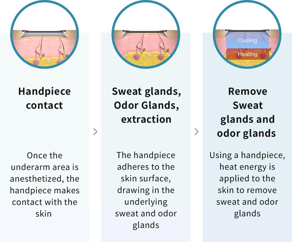 Principle of MiraDry