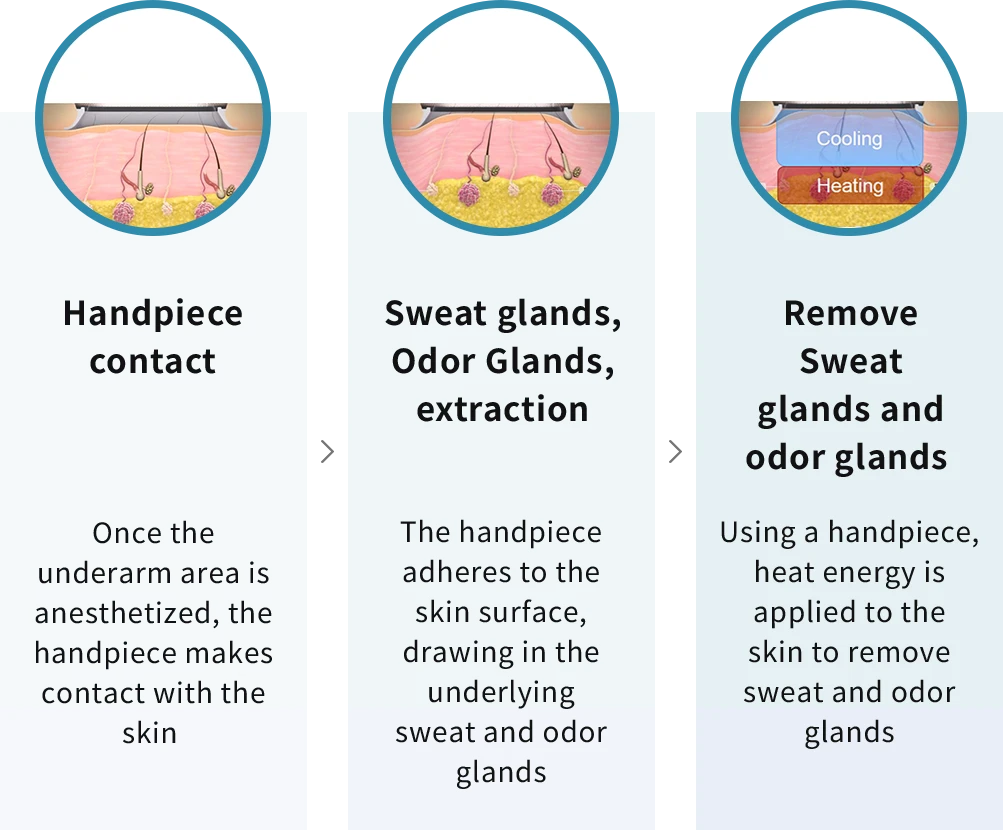 Principle of MiraDry