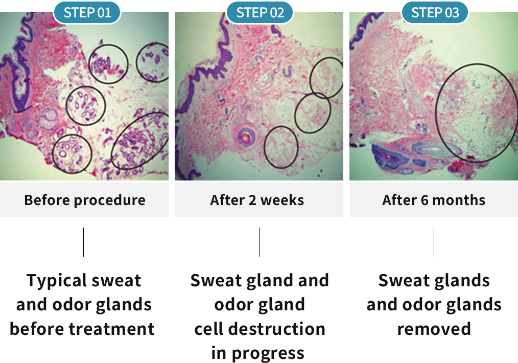 Sweat Gland