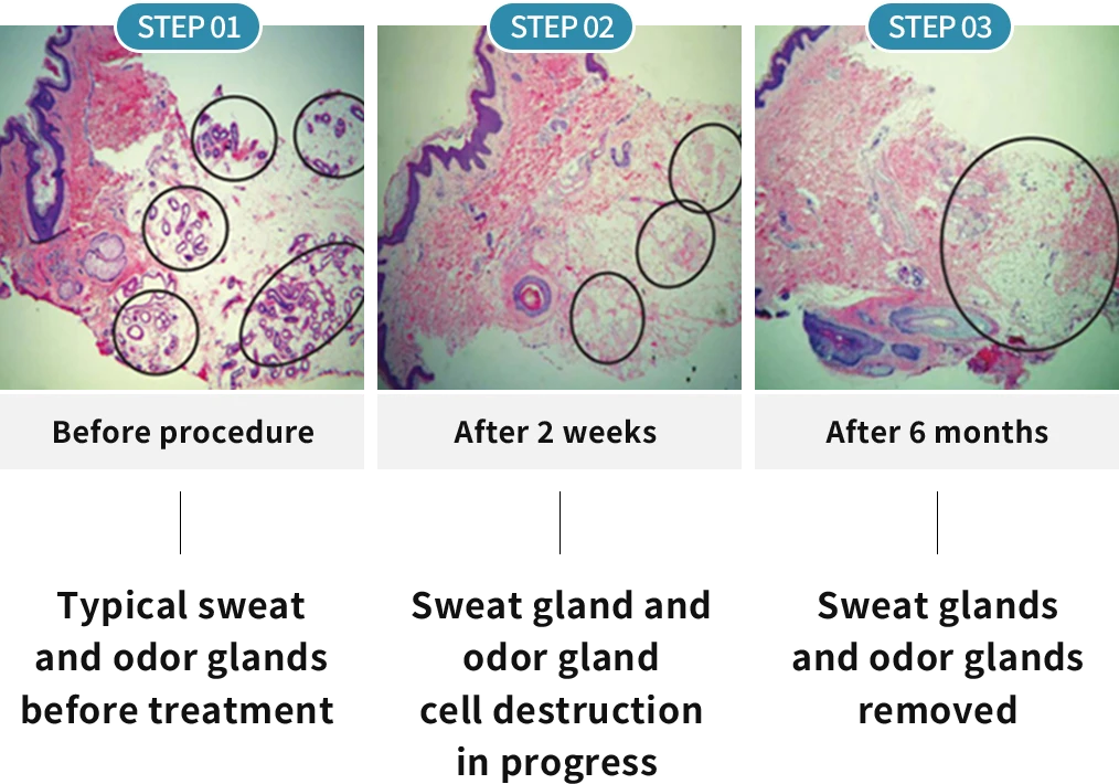 Sweat Gland