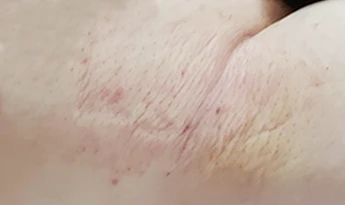 Procedure
