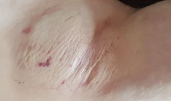 Procedure