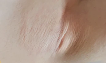 Procedure