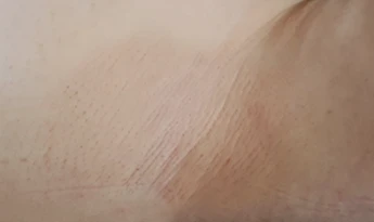 Procedure