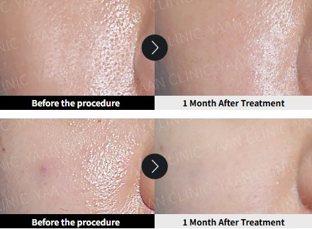 Juvelook skin booster before and after Korea acne scars