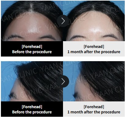 Juvelook Volume Korea forehead treatment before and after at YAAN Clinic
