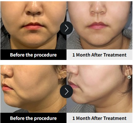 Before and after Ultherapy Prime treatment at YAAN Clinic, Gangnam Seoul