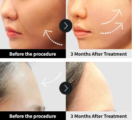 Face Volume Filler before and after results at Yaan Clinic Gangnam Seoul