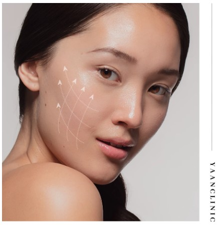 Reddit reviews of Silhouette Soft Korea thread lifting results