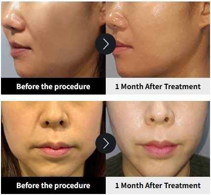 Ulthera treatment before and after results at YAAN Clinic Gangnam Seoul