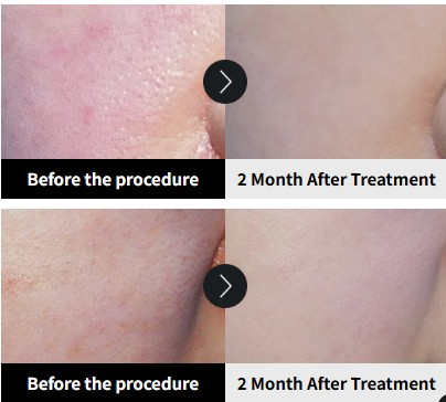 Potenza Microneedling Korea before and after results at YAAN Clinic