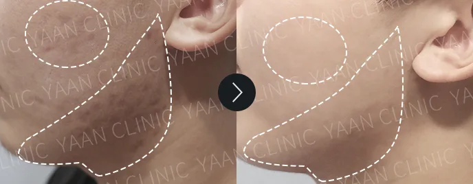 Artecoll filler before and after, Acne scars, case 1 — Before & After (Yaan Clinic, Gangnam)