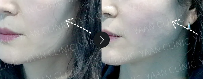 Artecoll filler before and after, Side Cheeks, case 2 — Before & After (Yaan Clinic, Gangnam)