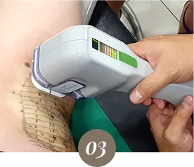 ภาพคลินิก: การรักษา miraDry LDM Healing Therapy WHY?