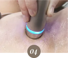 ภาพจากขั้นตอน miraDry fresh ที่คลินิก: LDM Healing Therapy WHY?