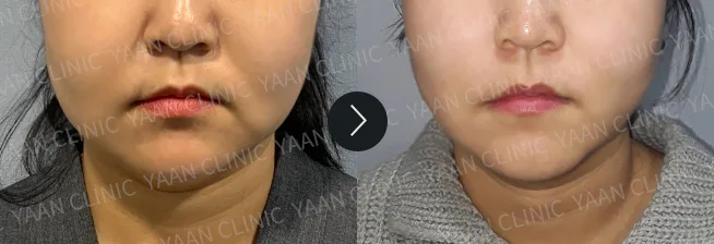 Before and after 1 month: Ultherapy Prime - case 5