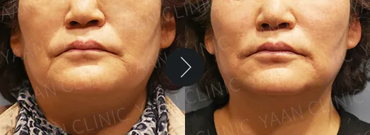 Before and after: Silhouette Soft thread lifting on the face - case 1