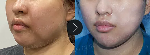 Before and after 1 month: Dual Titanium Lifting on the face - case 1