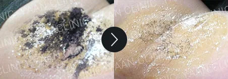 Before and after 1 month: miraDry fresh on the underarm - case 1