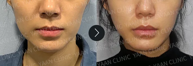 Before and after 1 month: Thermage FLX on the face - case 2