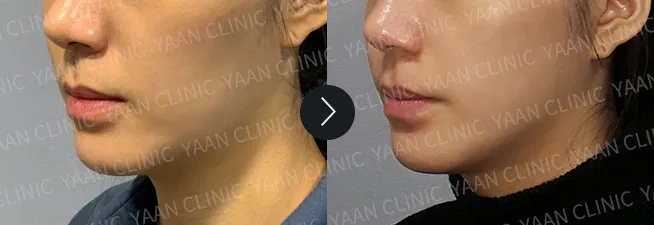 Before and after 1 month: Thermage FLX on the face - case 7