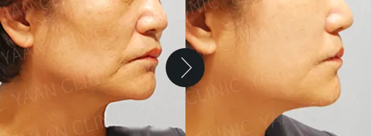 Before and after: Silhouette Soft thread lifting on the face - case 4