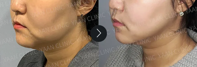 Before and after 1 month: Ultherapy Prime - case 6