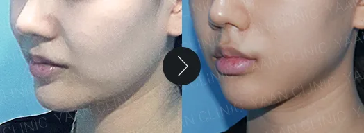 Before and after 1 month: Dual Titanium Lifting on the face - case 2