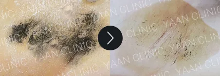 Before and after 1 month: miraDry fresh on the underarm - case 2