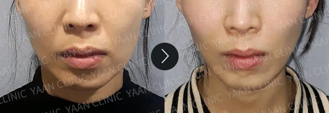 Before and after 1 month: Thermage FLX on the face - case 6