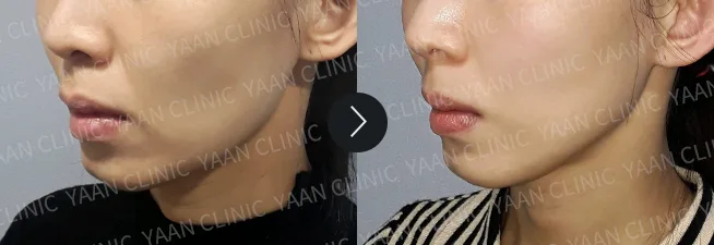 Before and after 1 month: Thermage FLX on the face - case 5