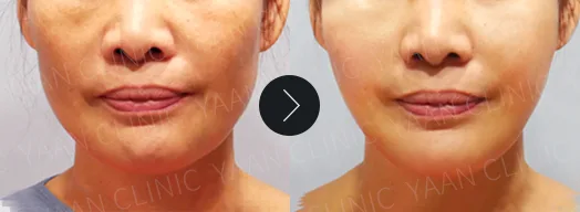 Before and after: Silhouette Soft thread lifting on the face - case 2