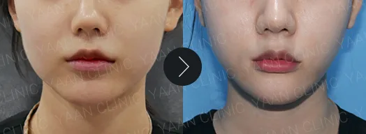 Before and after 1 month: Dual Titanium Lifting on the face - case 3
