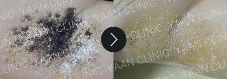 Before and after 1 month: miraDry fresh on the underarm - case 3