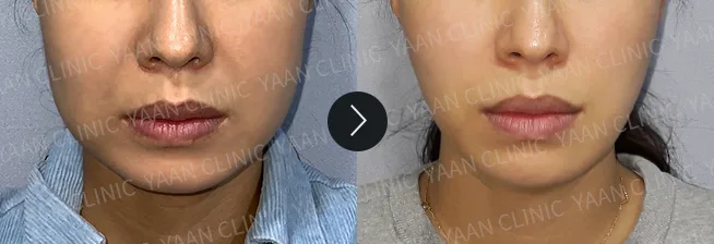 Before and after 1 month: Ultherapy Prime - case 4