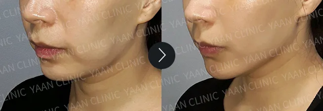 Before and after 1 month: Thermage FLX on the face - case 3