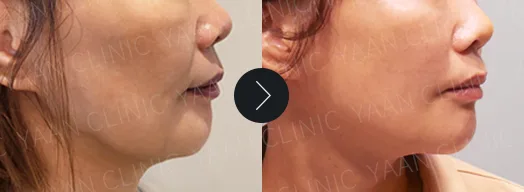 Before and after: Silhouette Soft thread lifting on the face - case 5