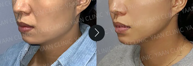 Before and after: Ultherapy Prime on the face and jawline - case 7