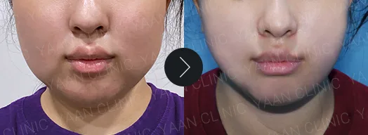 Before and after 1 month: Dual Titanium Lifting on the face - case 4