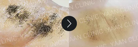 Before and after 1 month: miraDry fresh on the underarm - case 4