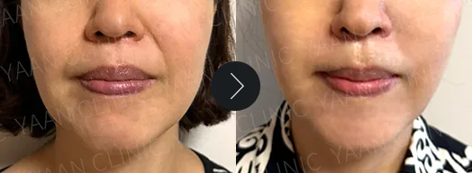 Before and after: Silhouette Soft thread lifting on the face - case 3