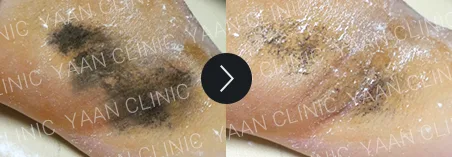 Before and after 1 month: miraDry fresh on the underarm - case 5